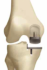 人工膝関節部分置換術