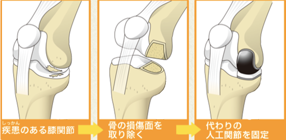 人工膝関節部分置換術の手順