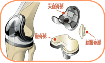 人工膝関節の構造