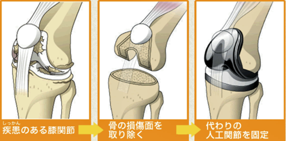 人工膝関節全置換術手順