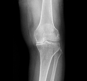 変形性膝関節症　レントゲン写真