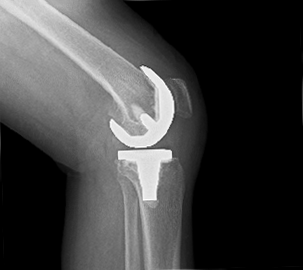 人工膝関節全置換術後のレントゲン写真