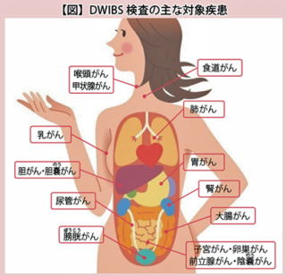 DWIBS検査の主な対象疾患