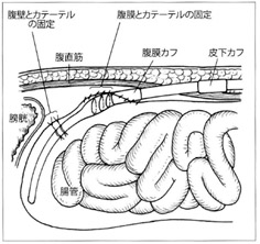 腹膜透析カテーテル留置方法